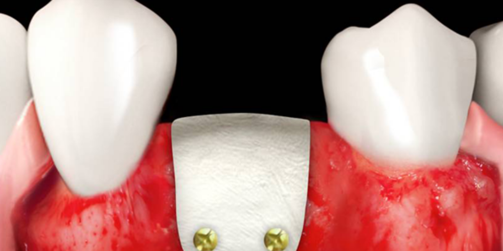 Osteobiol_lamina_updent